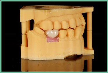 “以科技破局，以数字化赋能”——ng28南宫与精瓷义齿共创齿科3D打印医疗新未来05