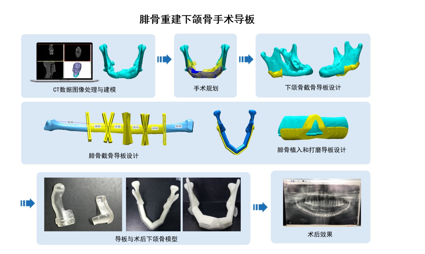 3D打印医疗应用
